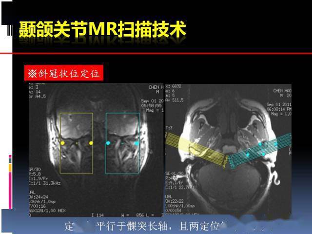 颞下颌关节的磁共振成像(检查技术与解剖部分)_影像_张静坤_腹股沟