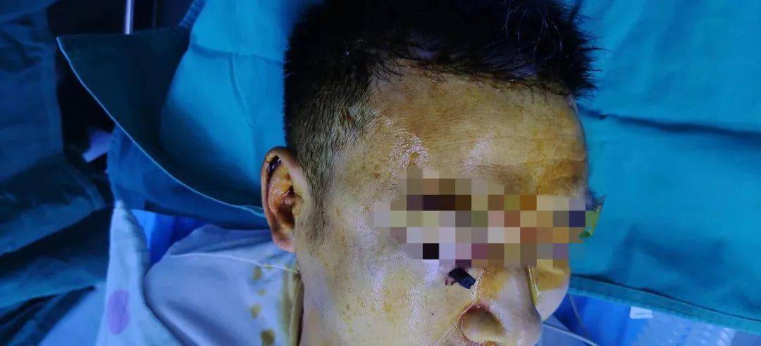 接诊医生许兰兰回忆起这个场面时仍皱起眉头说,筷子插入眼睛真是很