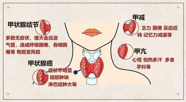 健康甲狀腺癌為何成為增長最快的腫瘤