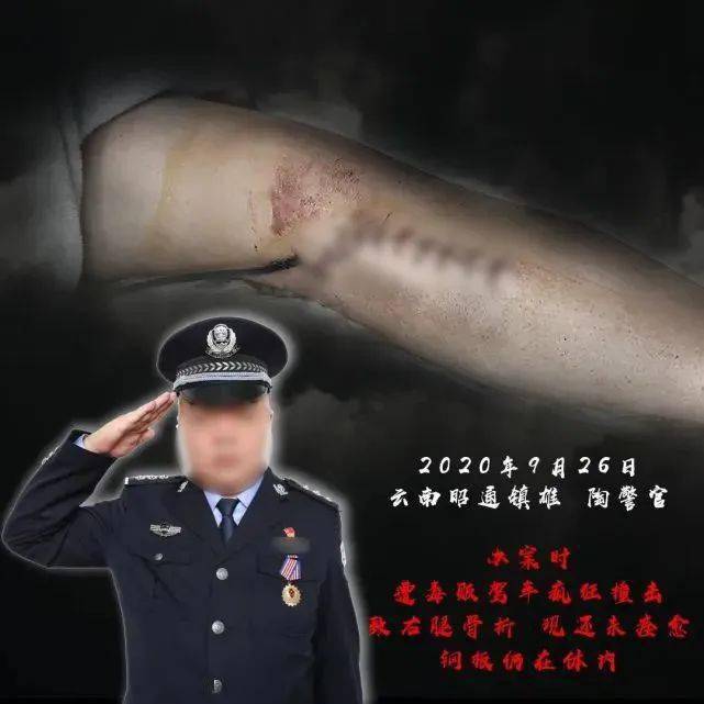 腿上留下了長長的疤痕致右腿骨折他遭毒販駕車瘋狂撞擊一次收網行動中