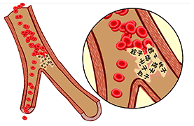 【专家在线】静脉溶栓是脑梗死最有效的治疗方法_患者_医生_时间窗