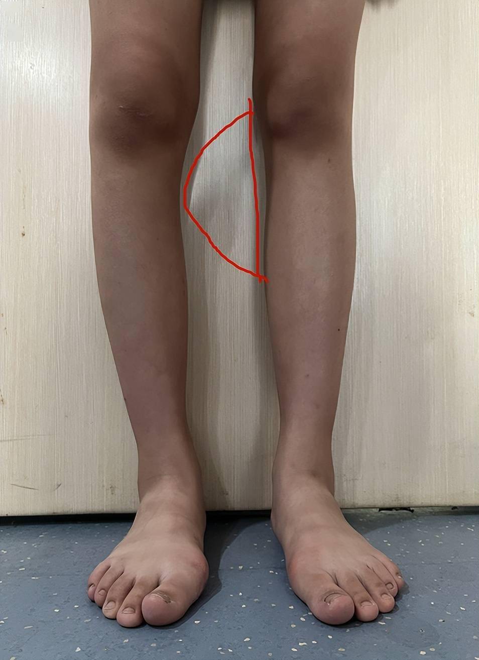 导致肢体短缩,严重畸形和(或)成角,影响儿童生长发育