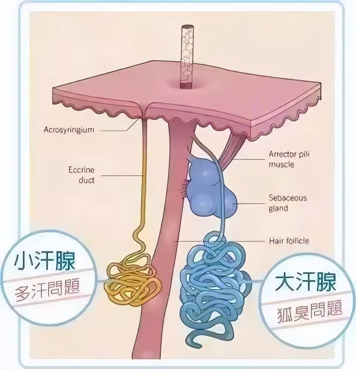 目前普遍较认可的理论认为,腋窝区存在小汗腺,顶泌汗腺(大汗腺)及大小