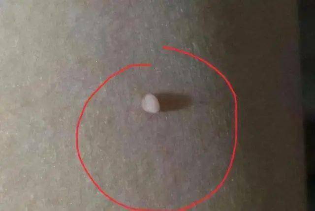 丝状疣丝状疣是小肉粒病变之后的一种名称,丝状疣主要是由人乳头瘤