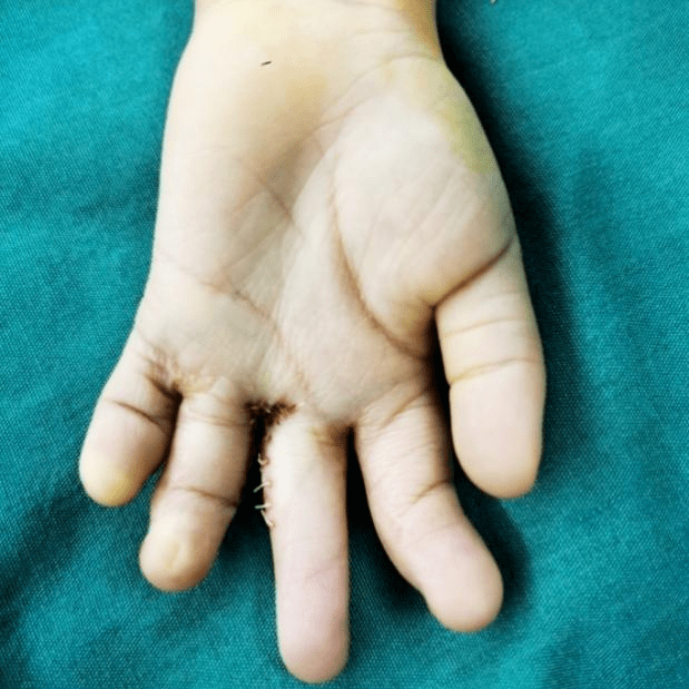 宝宝先天性多指畸形,别担心,我们有办法!_poland_综合征_波兰