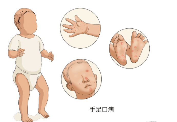 夏天幼兒手足口病常發孩子有這幾個症狀趕緊就醫