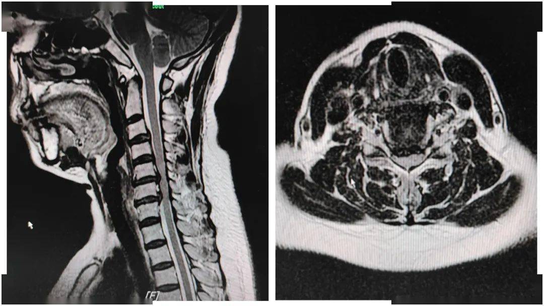 入院核磁共振检查示:颈4/5,5/6,6/7椎间盘突出,诊断:神经根型颈椎病