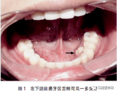 舌侧隆突的位置图片图片