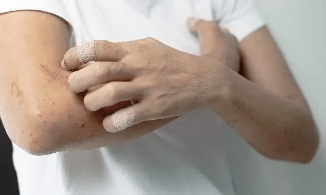 但是长期的搔抓可能会出现抓痕,血痂,皮肤苔藓样变等继发性的皮损.