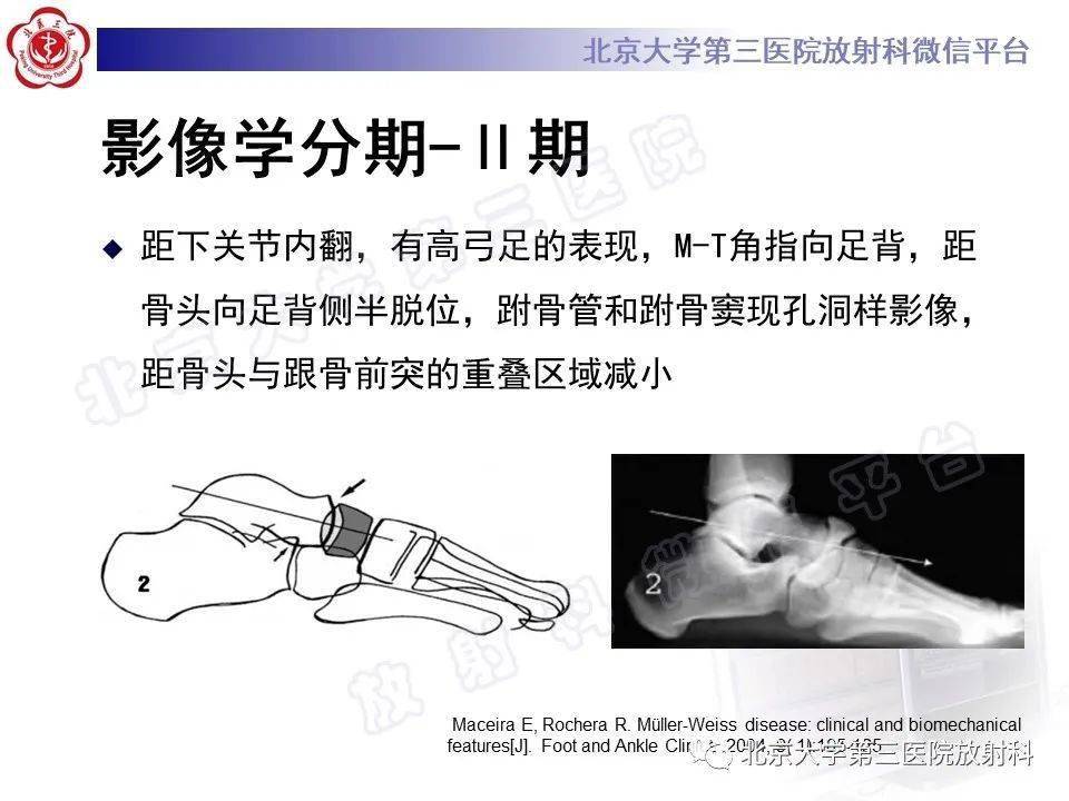 成人足舟骨坏死_平台_解剖_髌骨