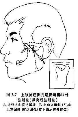 面部阻滞麻醉点图图片