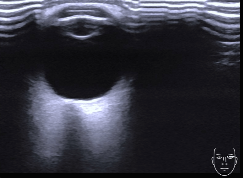 正常晶体无回声,后囊膜呈不完整的弧形强回声,玻璃体为完全的