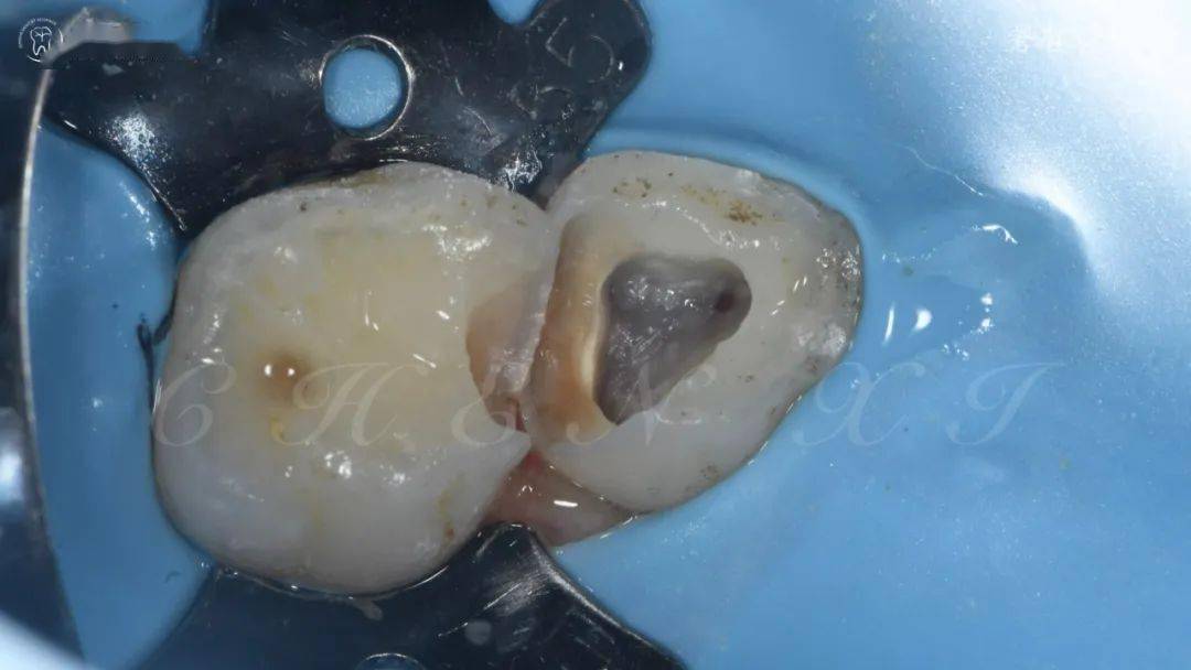 值得收藏的乳磨牙的根管治疗…_显微镜_侧根_口腔