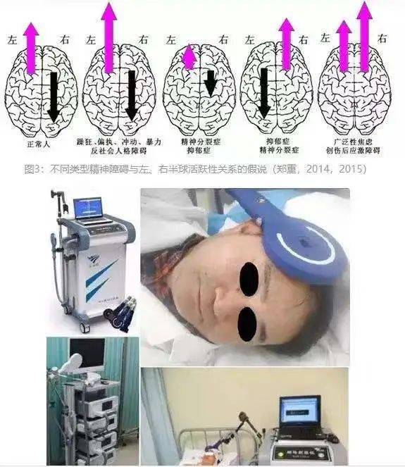 康复科神器经颅磁刺激技术你竟然还不知道