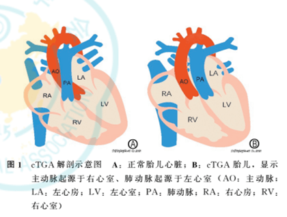 大动脉转位解剖图图片