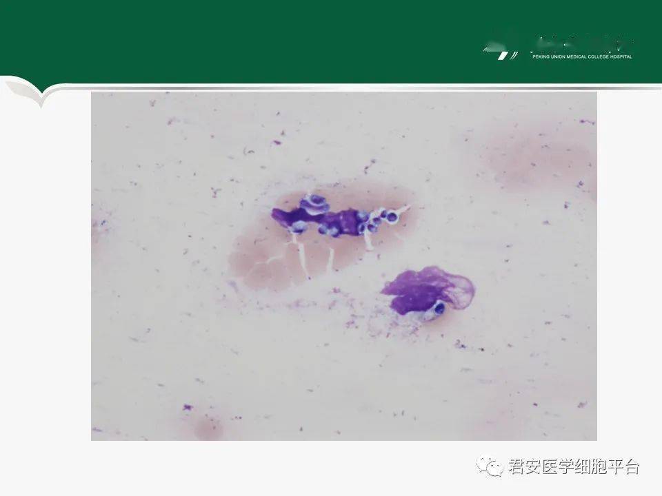 低白细胞外周血涂片发现马尔尼菲篮状菌一例