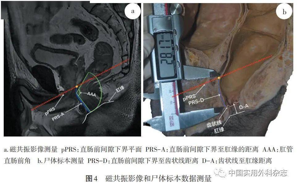直肠尿道肌的解剖特点和临床意义 乙状结肠远端结肠浆膜下的3条结肠带