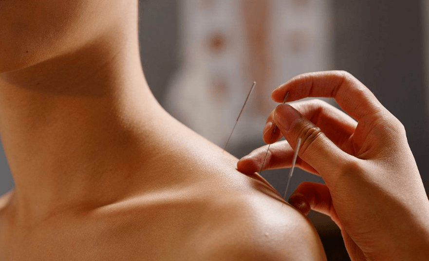 针灸减肥是您不错的选择