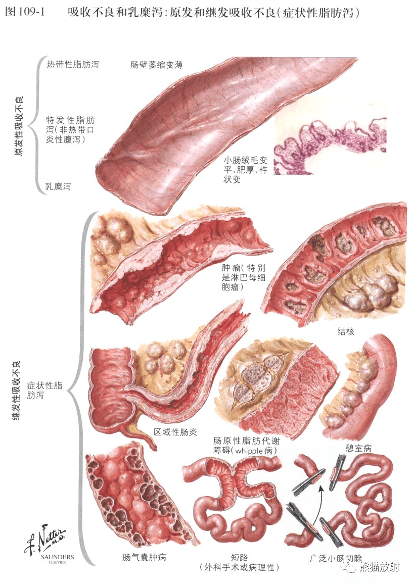 奈特圖譜丨小腸解剖及相關疾病