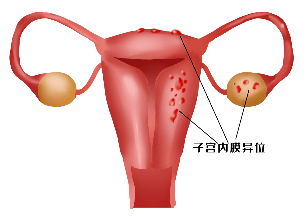 建議定期體檢,一旦發生扭轉早期手術治療;卵巢黃體囊腫破裂或血腫,則