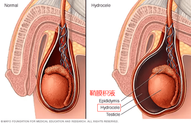 不同的是,鞘膜积液是睾丸鞘膜腔里面的液体积聚过多,形成包块;而疝气