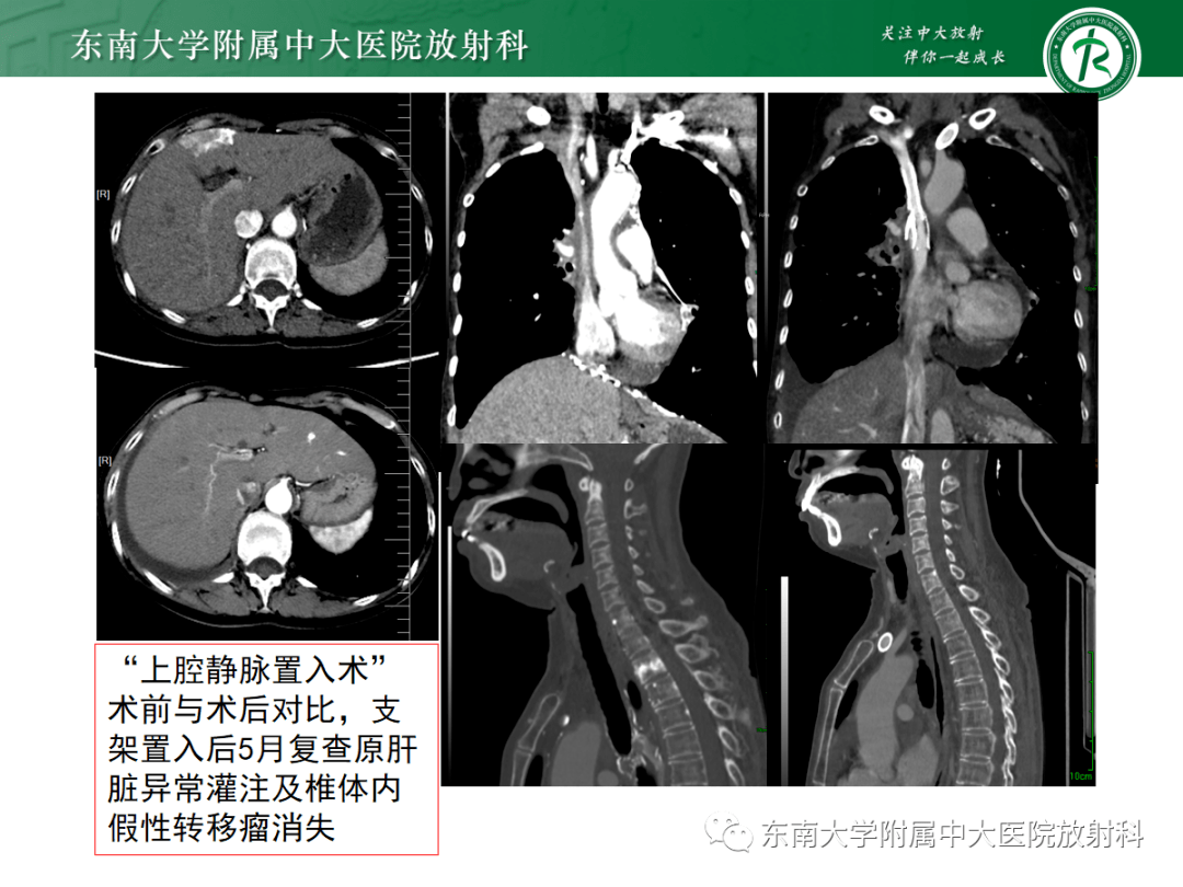 上腔静脉压迫图片