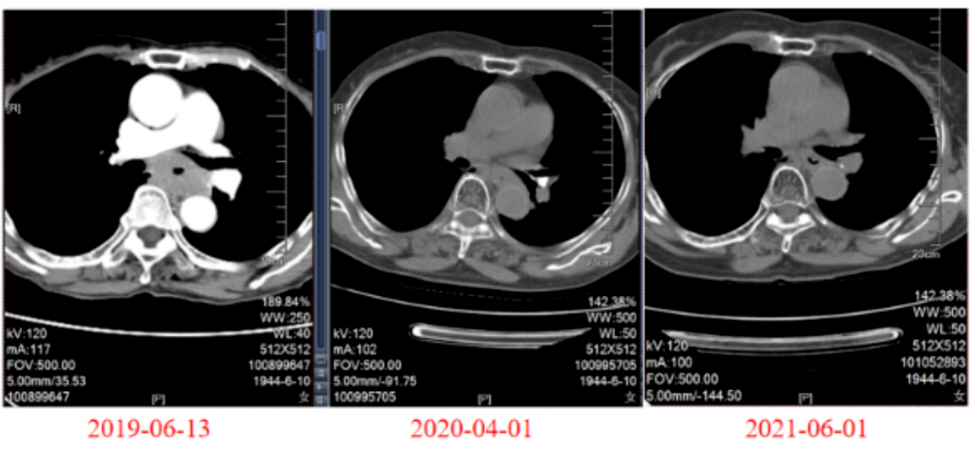 医食无忧艾赋新生放疗联合卡瑞利珠单抗治疗老年局部晚期食管癌为患者