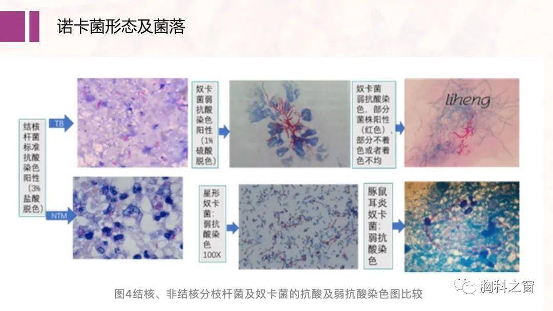 菌主要经呼吸道或创口侵入引起化脓性感染,多造成肺型,播散型诺卡菌病