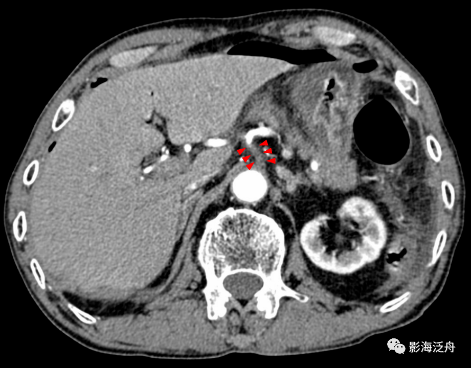 這例急診胃穿孔,背後的原因意想不到!_動脈_血管_腹腔