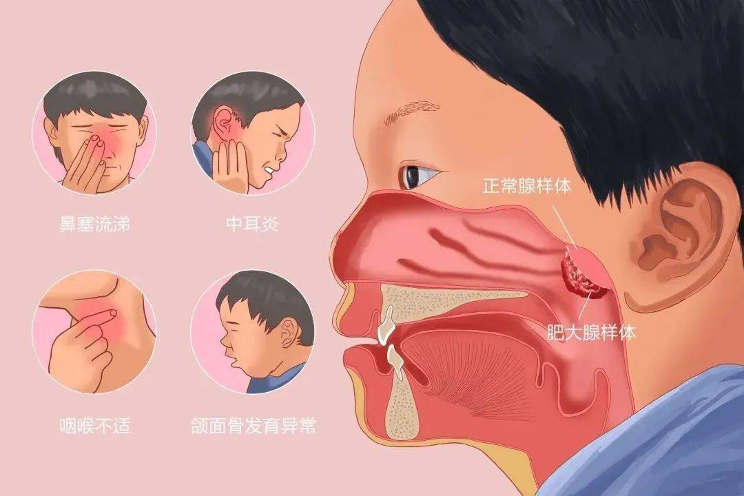 儿童鼾症背后危害难以想象,需查明病因及早干预!_影响_孩子_分之二