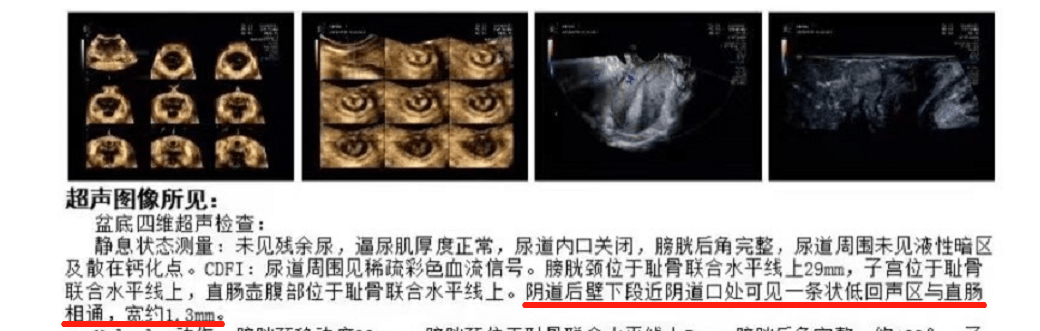 急产妈妈遭遇罕见直肠阴道瘘_小蔡_手术_会阴