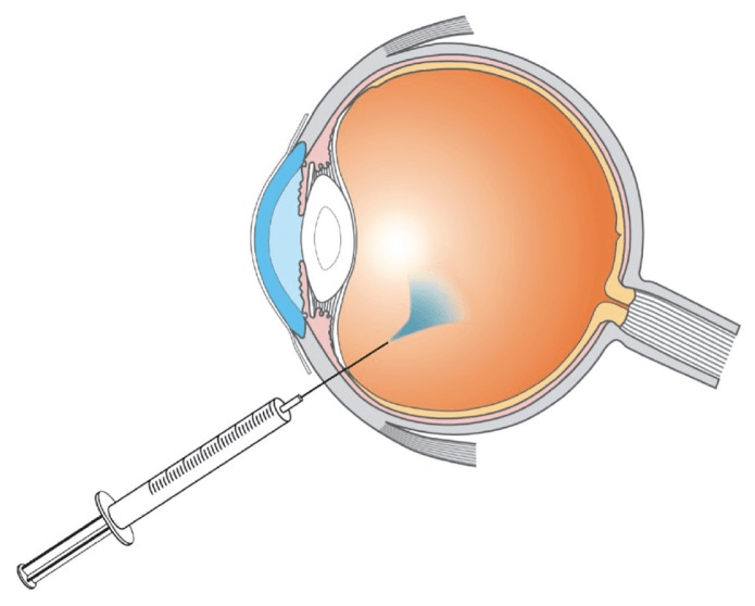 科学家发现它和许多视网膜疾病都有关系;而向玻璃体腔中注射抗vegf