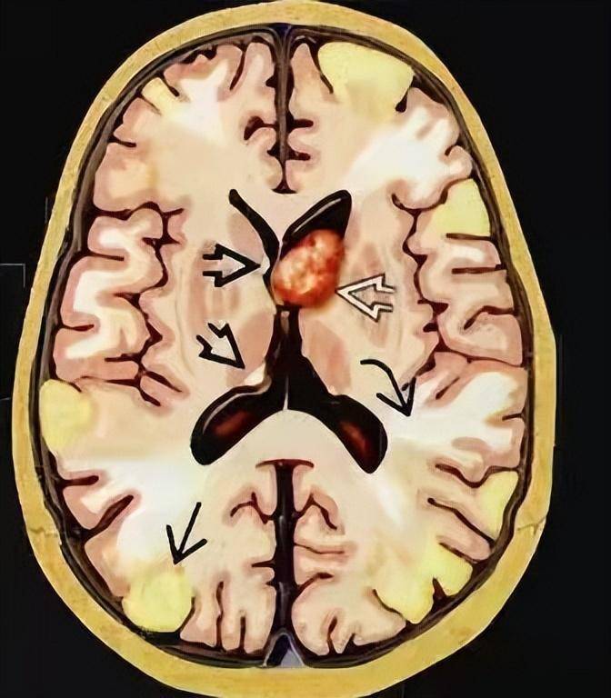 臨床治療主要有mtor抑制劑治療,是對結節性硬化的病因治療.