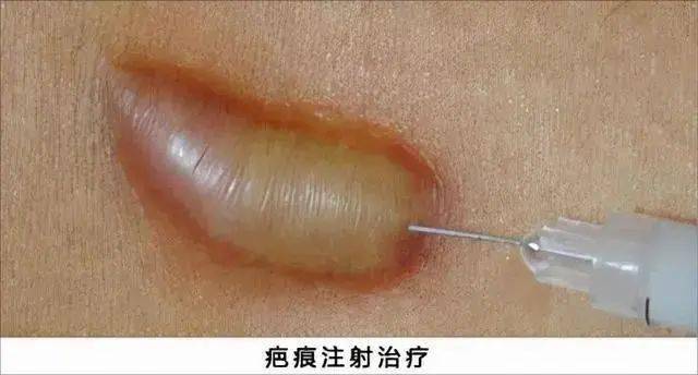 【医文医话】 节阳华:瘢痕疙瘩的治疗_手术_放疗_方法