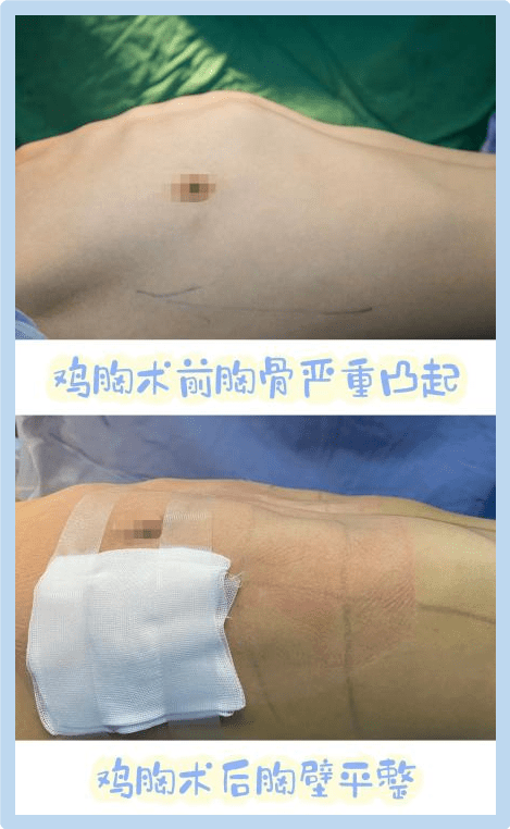漏斗胸术后照片图片