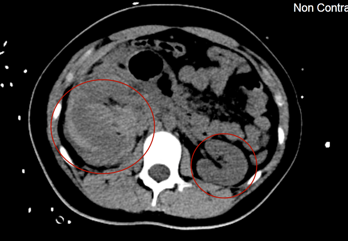 右肾破裂伤伴肾周血肿形成 3.全身多发骨折4.肺挫伤,此时患儿
