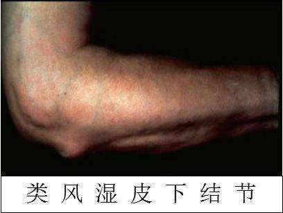 类风湿结节(rheumatoid nodules 多位于关节隆突及受压部位的皮下