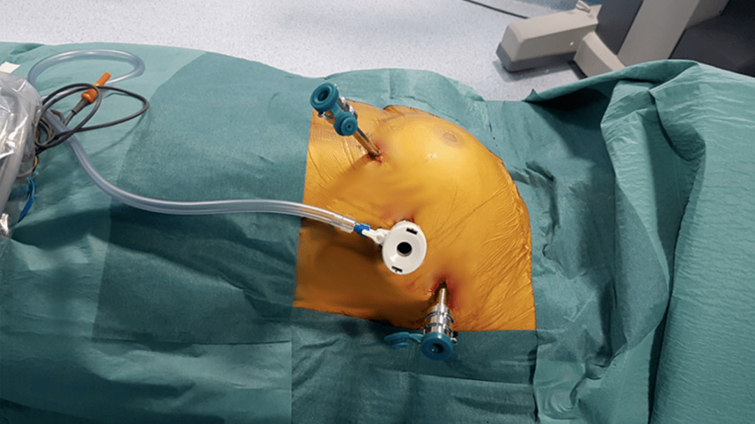 胆囊切除术体位图片