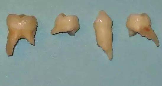 乳牙牙根形状图片
