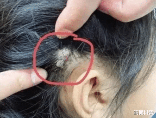 "夺命蜱虫"有多可怕?集吸血和寄生于一体,如何处理才正确?