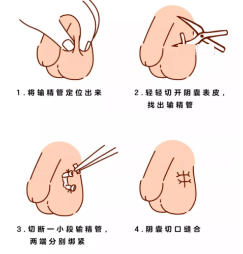 男性结扎的好处有哪些?_避孕_结扎手术_睾丸