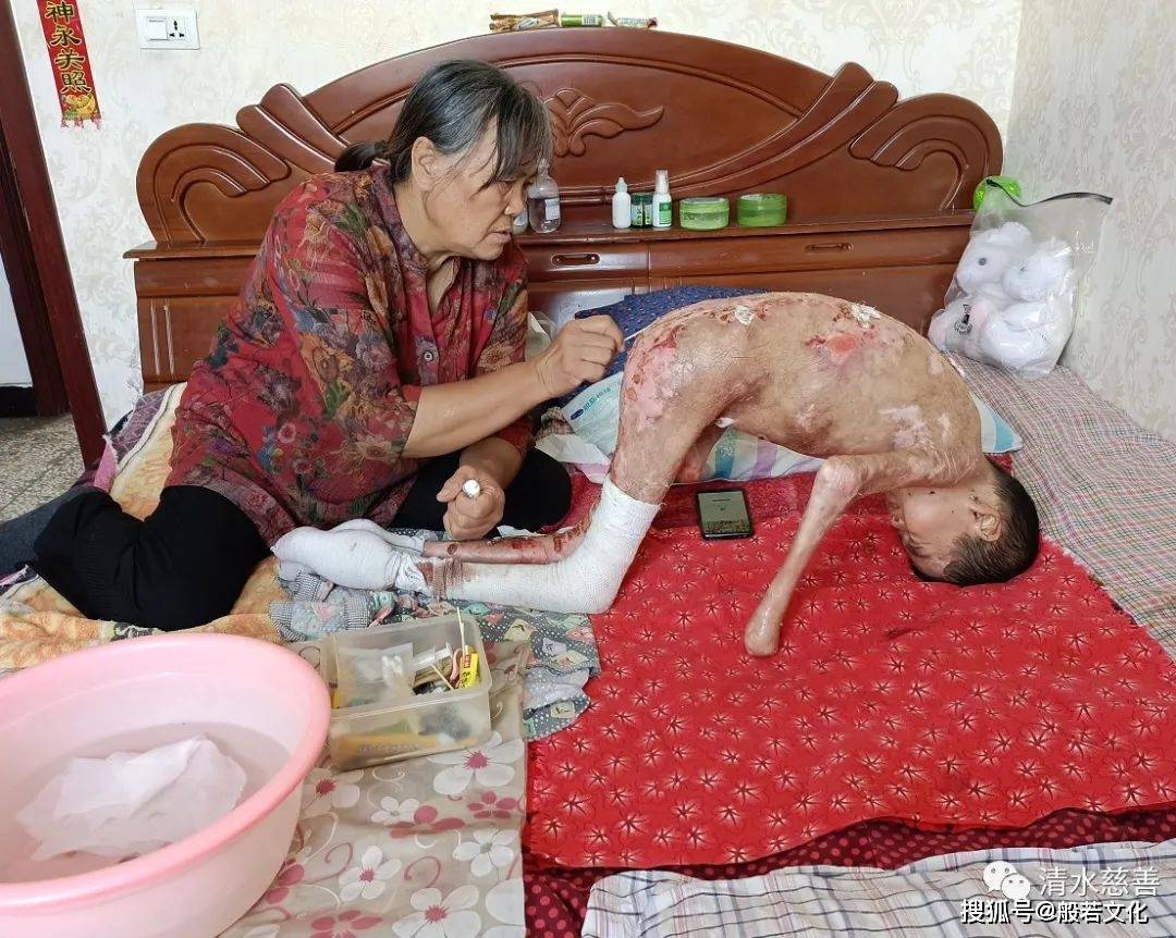 清水慈善再次探望"玻璃男孩":他的康复梦实现了吗?