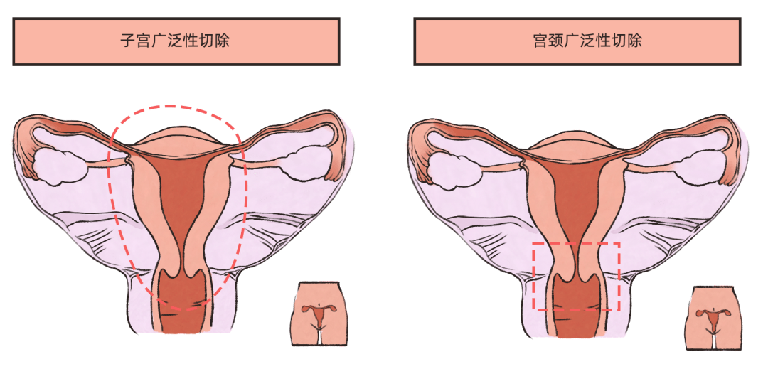 26岁女子阴道出血,一查竟是宫颈癌,差点失去了做母亲的机会_晓丽_筛查