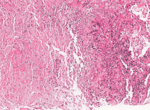 【衡道丨病例】肺麴黴菌病(pulmonary aspergillosis)如何診斷?