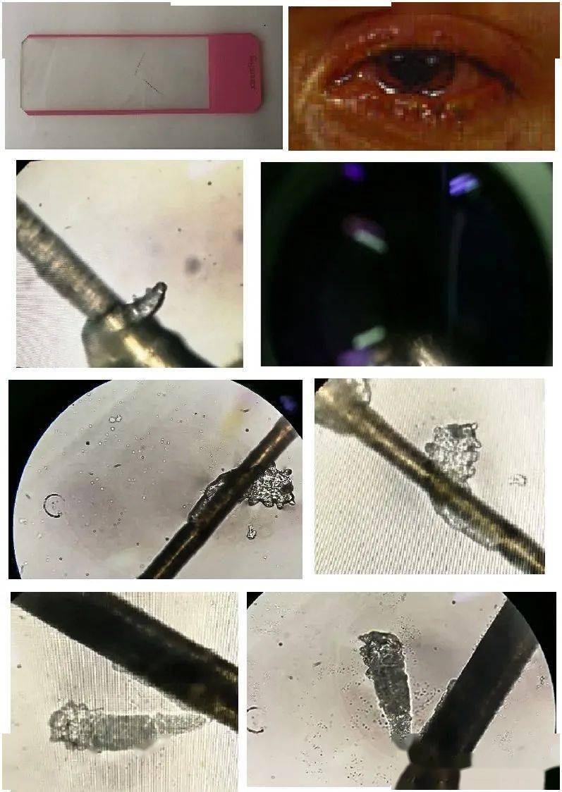 检查_检验_阴虱