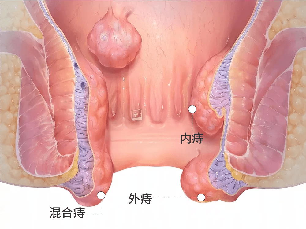 失力(屁股包不住屎)肛口狭窄(拉屎只能拉面条状)比如:而且没人告诉过
