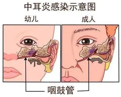 有的小朋友耳朵疼得连碰都不能碰检查后发现这都是外耳道炎惹的祸!