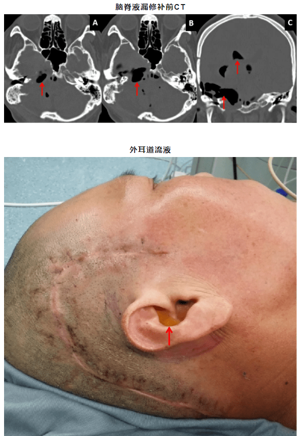 側顱底腫瘤手術入路選擇探討——三博腦科張明山_耳科_聽神經_乙狀竇