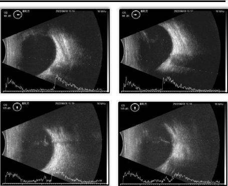 6岁孩子患上青光眼,祸起剪刀扎伤眼_眼睛_机械性_致盲