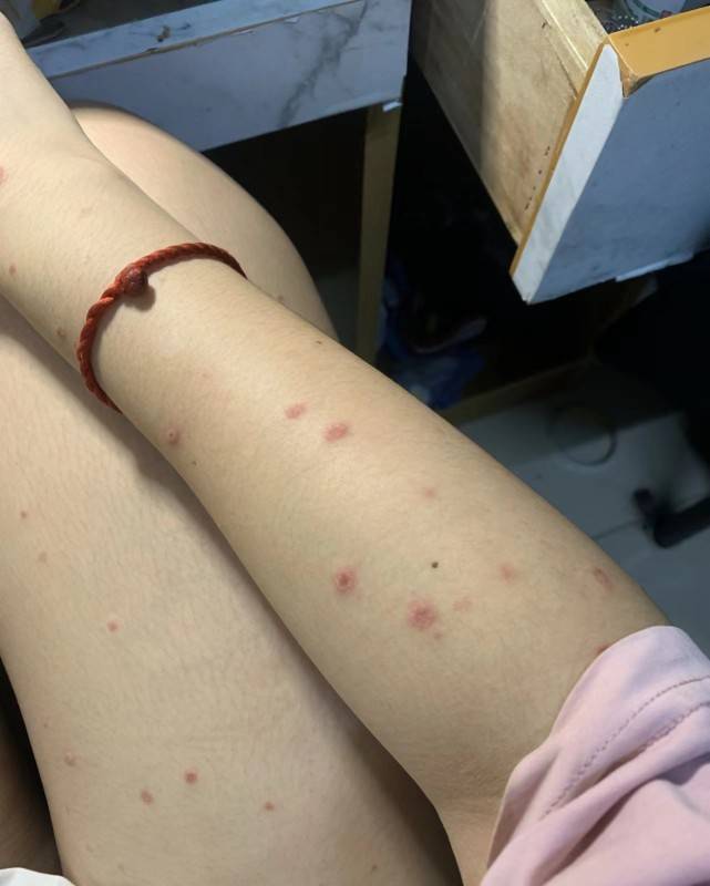 丘疹性荨麻疹必看!过来人1年患病经验总结,不看可就吃大亏了!_医生_折